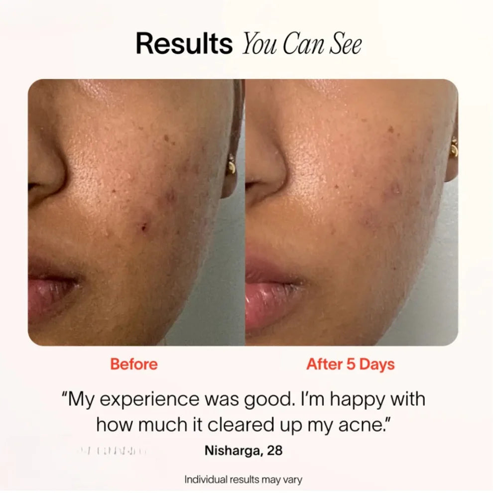 PureSpot™️ - 3-Minute Pimple Spot Treatment